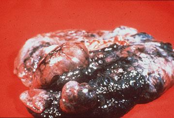 emphysema.jpg (19943 bytes)