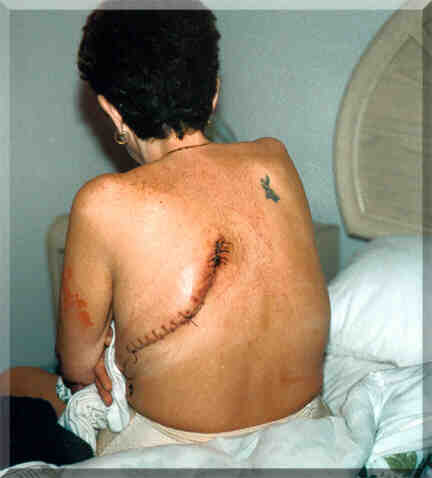 Kim was 44 years old and a life-long smoker who quit immediately once diagnosed with lung cancer.  This photograph of the scar on her back was taken following removal of her left lung.