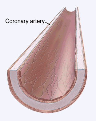 Dartmouth animation showing coronary artery disease plaque buildup