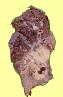 This is a large squamous cell cancer tumor that has developed a cavity. 