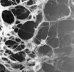 emphysema