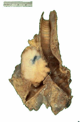 lung cancer lung cancer