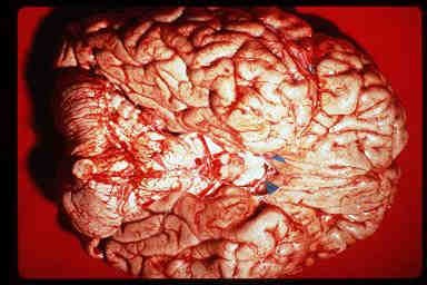 تصویری از پایه مغز