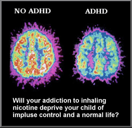 Brain scans comparing attention deficit hyperactivity disorder or ADHD to no ADHD, with the caption Will addiction to inhaling nicotine cost your child impulse control and a normal life?