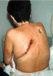 Kim's lung removal surgery scar