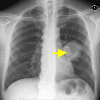 A chest x-ray showing a lung cancer tumor.