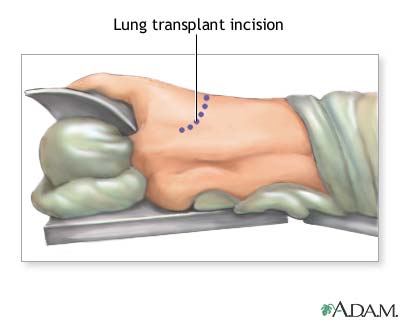 Picture showing the backside incision site durng lung replacement surgery