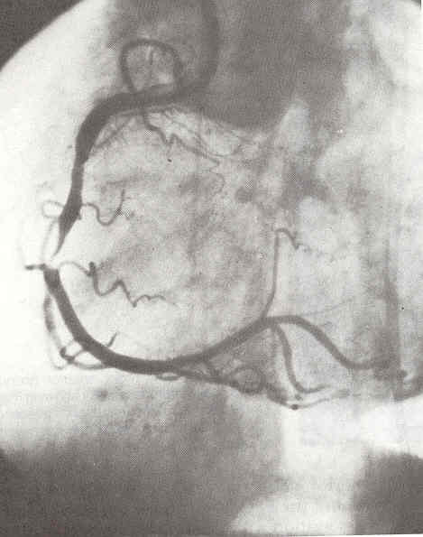coronary artery with tight narrowing affecting the mid segment - RCA lesion