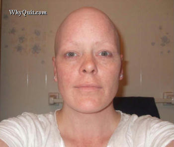 A picture of 38-year old Deborah Scott with her head shaved after undergoing treatment for lung cancer.